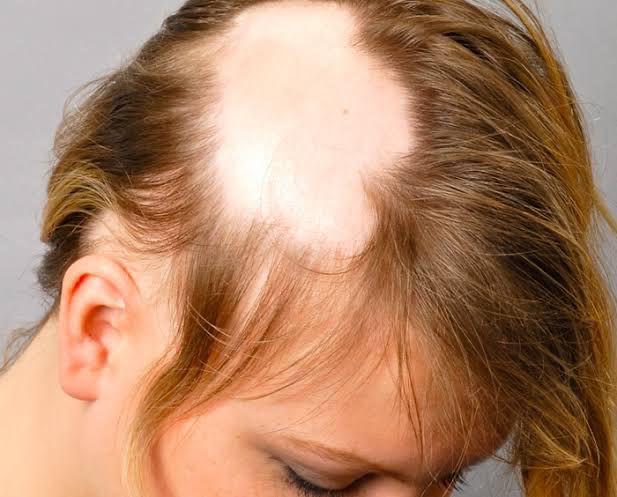 Pueden mujeres con alopecia experimentar trastornos emocionales graves